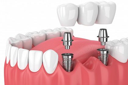 Мост или имплантат: что выбрать? Рекомендации стоматологов