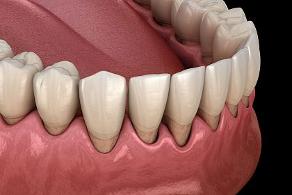Что такое клиновидный дефект зубов
