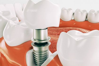  Имплантация зубов: современные методы и преимущества