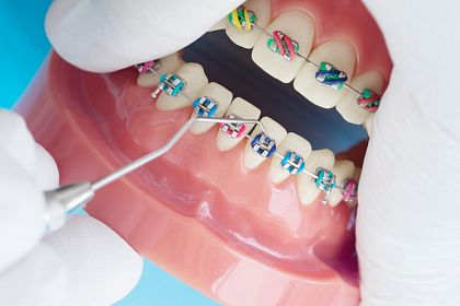 Ортодонтия для детей: когда начать и какие преимущества