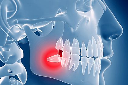 Лечение и удаление зубов мудрости: что нужно знать пациентам